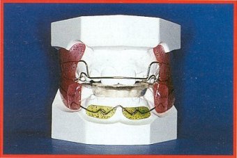 Frankel modificato dal dr. Orton