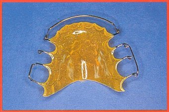 Placca di Hawley modificata