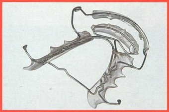 Spring Aligner superiore n3