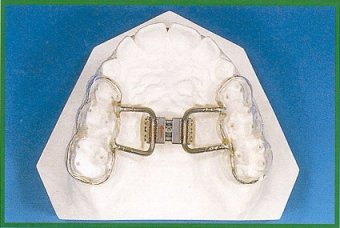 Disgiuntore con rialzi occlusali laterali (Vite Forestadent)