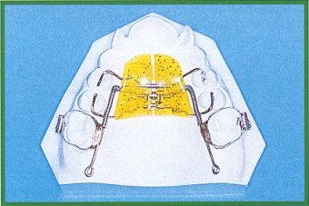 H distalizzante numero 5