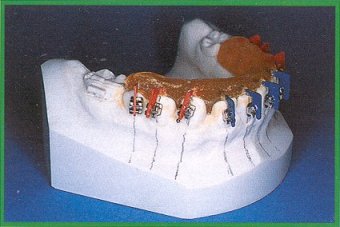Attacchi vestibolari sistema indiretto