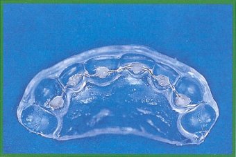 Retainer con basi retinate