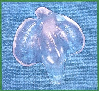 Placca otturatrice per labiopalatoschisi