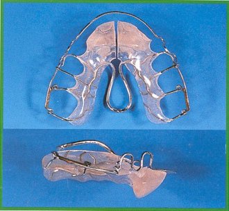 Dispositivo superiore con vallo inferiore fisso (Hillegonsbergher)