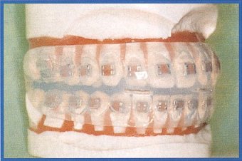 Multilastodontic Finischer