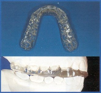 FL.O.S. Flat Occlusal Splint