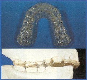 STA.S. Stabilization Splint