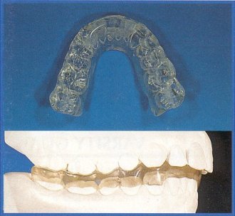 MA.RE.S. Mandibular Repositioning Splint