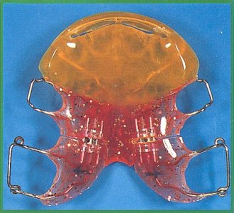 Dispositivo palatale con viti sagittali