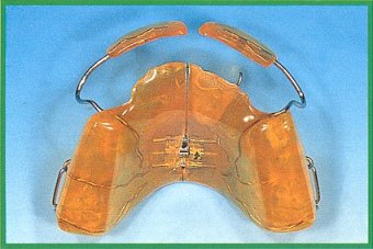 Dispositivo palatale di III classe