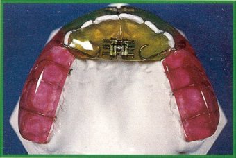 Bio-Sagittal Maxillary