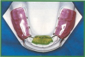 Bio-Sagittal Mandibular