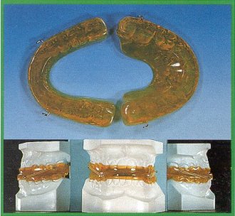 Twin Bite Plane di III classe