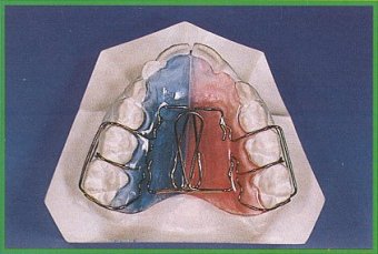 Dispositivo con doppia molla di Coffin