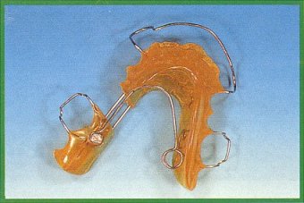 Dispositivo superiore per la distalizzazione del I e II molare permanente